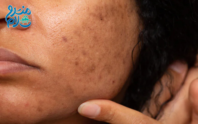 درمان لکه های پوستی با روغن خردل